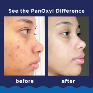 panoxyl-10-benzoyl-peroxide