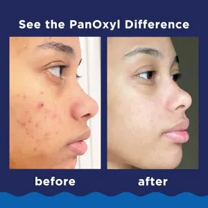 panoxyl-10-benzoyl-peroxide