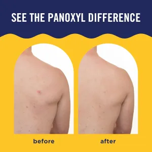 panoxyl-body-acne-spray