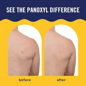 panoxyl-body-acne-spray