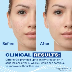 differin-acne-retinoid-gel