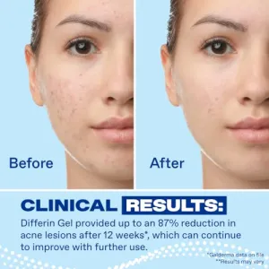 differin-acne-retinoid-gel